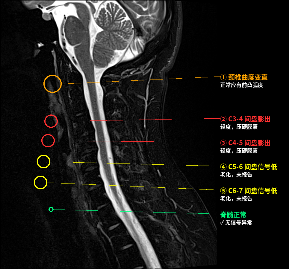 颈椎侧面标注